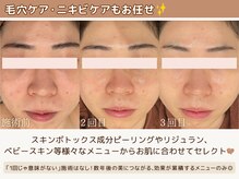 種類豊富な美肌ケアから最もお肌に合ったものでつやつや白玉肌に