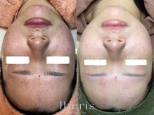 ビーグロウ(be Grow)の雰囲気（毛穴黒ずみのお悩みお任せ下さい☆ニキビ/毛穴/肌質改善）