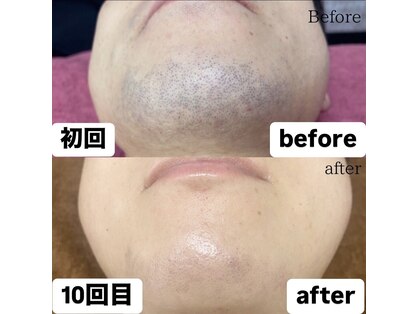 メンズ脱毛サロンKurozukin　天王寺店の写真