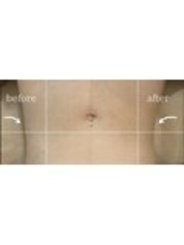 リフト 門前仲町(Lift)/小顔専門店Lift|Before After
