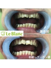 ルブラン 奈良店(Le Blanc)/ホワイトニングをお試しで！