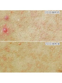 おうちサロン ミキ/背中ニキビケアに◎Wピーリング