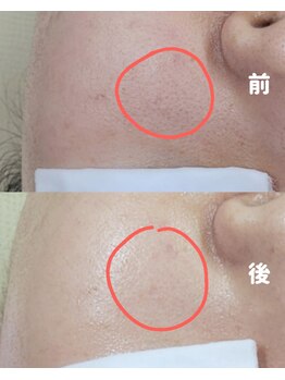 チョンダムビューティー(chondam beauty)/ハイドロフェイシャル効果実感!