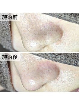 美鼻ラボ 押上 曳舟/産毛詰まりだったらラッキー★