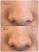 ザ フェース 京都御池店(THE FAITH)/1度の生コラーゲンの変化