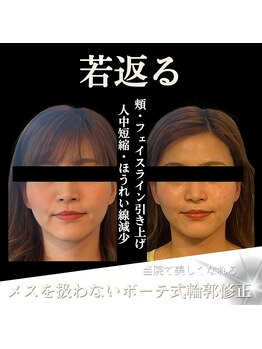 クリニカルボーテ 心斎橋院(CLINICAL BEAUTE)/人中と小鼻はケアしないと広がる