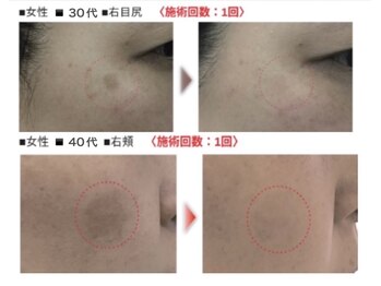 エードット(A.)/シミケア