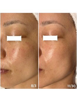 楚々(SOSO)/施術4回目