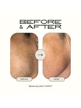 カラット(CARAT)/メンズ髭脱毛