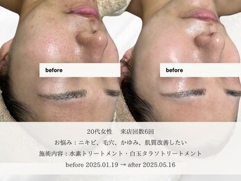 エメ 名古屋栄店(aimer)/SkinCare <肌管理・エイジング>