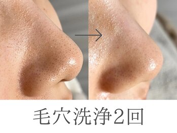 レイミー(reimee)の写真/医療提携サロンの毛穴洗浄×ピーリング×選べる仕上げケアで毛穴レス肌に