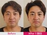 ≪スッキリした小顔へ≫ メンズ美容頭蓋小顔矯正