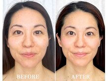 ドクターボディ 新宿店(Dr.Body)/【面長/歪み/中顔面 40代】　