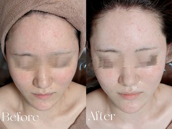 ウィハナ(wehana)/【ハーブピーリング】赤みケア