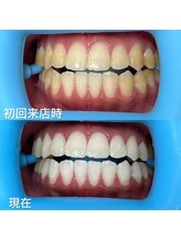 ホワイトニングセンター 富山二口店/富山　二口町ホワイトニング