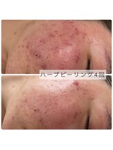 ネージュ(Neige)/ハーブピーリング4回