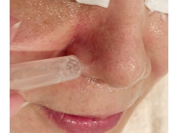 A&A 小山VAL店/毛穴吸引ケア