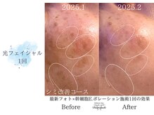 ディアスマイル(Dear.smile)/最新光フェイシャル1回