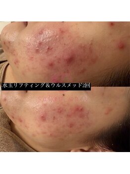 ヴェアリー 広尾(VARY)/ウルスメッド2回