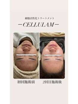 リバイセリー(Revicelly)/2回目の変化