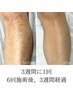 【新規男性/初めての脱毛で迷ったらこれ！】ひげ込VIO無全身脱毛体験¥11000