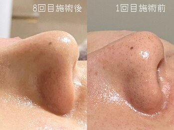 おうちサロン ミキ/鼻の黒ずみに【酸ピーリング】