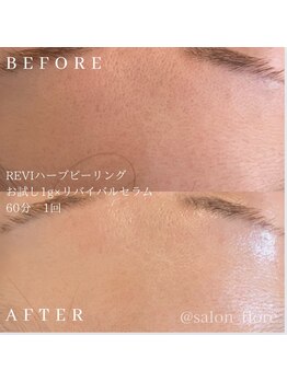 フローレ 平針店(Flore)/毛穴詰まり・開きが気になる方へ