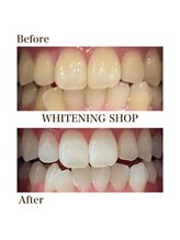 ホワイトニングショップ 恵比寿店/【Before　After】フリーパス