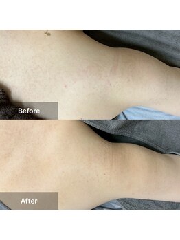 モカ 天王寺店(MOKA)/剥離3回目 二の腕 背中