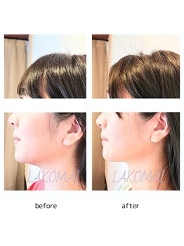 ラコマイ(LAKOMAI)/横顔美人!小顔リンパケア。