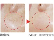 アリエルリッチの雰囲気（《美肌ケア》肌に優しいから続けられるシミケア※12回後）