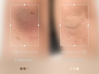 エメ(aimer)/LEMELLA《メラニンケア》