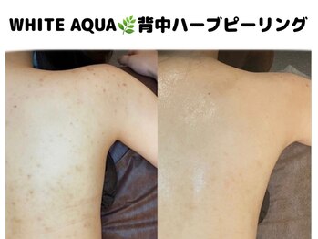 ホワイトアクア 柏店(WHITE AQUA)/背中ニキビケア/ザラつき/赤み