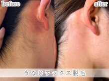 ミック(Mecc)/うなじワックス脱毛20分