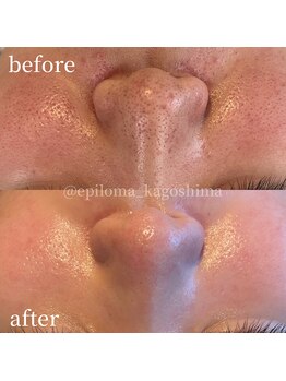 エピロマ(EPILOMA)/鹿児島市/宇宿/肌質改善