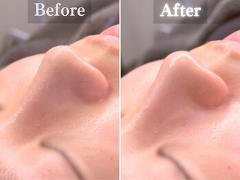 ボーンオム(Born Homme)/毛穴洗浄+美容液導入:20代男性