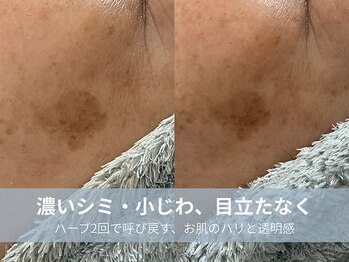 ラシック 加古川店(La chic.)の写真/気になるシミ・しわを集中ケア!ハーブピーリング2回で叶える、影のない明るい印象のエイジングケア