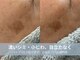 ラシック 加古川店(La chic.)の写真/気になるシミ・しわを集中ケア!ハーブピーリング2回で叶える、影のない明るい印象のエイジングケア