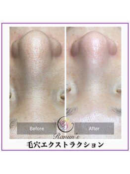 ラナン パラフューズ(Ranun's PARAFUSE.)/毛穴ビフォーアフター(2)