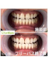 ルブラン 奈良店(Le Blanc)/10日間のケア！