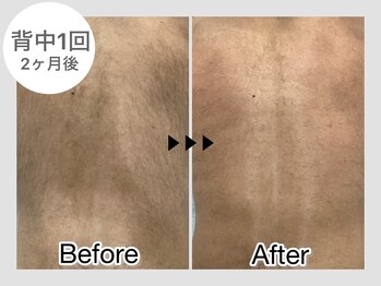 ナルシス/【脱毛】1回の変化★