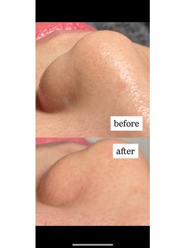 ニコラフ(Nico laugh)/毛穴洗浄