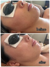 エイチビー(HB)/IPL光フェイシャル３回