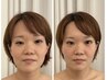 【ほうれい線、たるみ、目の窪み、顔が長くなった方】プレミアム小顔矯正
