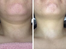 ドゥナ(DUNA)/女優ピーリング×ディープリフト