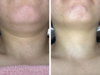 ドゥナ(DUNA)/女優ピーリング×ディープリフト