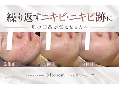 ブロッサム(Blossom)の写真