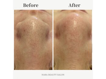 ナラビューティー(NARA BEAUTY)/ハイドラフェイシャル写真