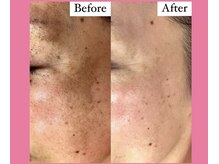 フェミニー(Feminy)/【ハーブ】シミ改善！