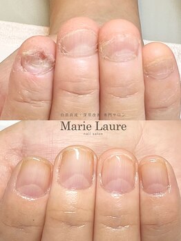 マリーロール 梅田店(Marie Laure)/自爪育成/深爪矯正/ネイルケア